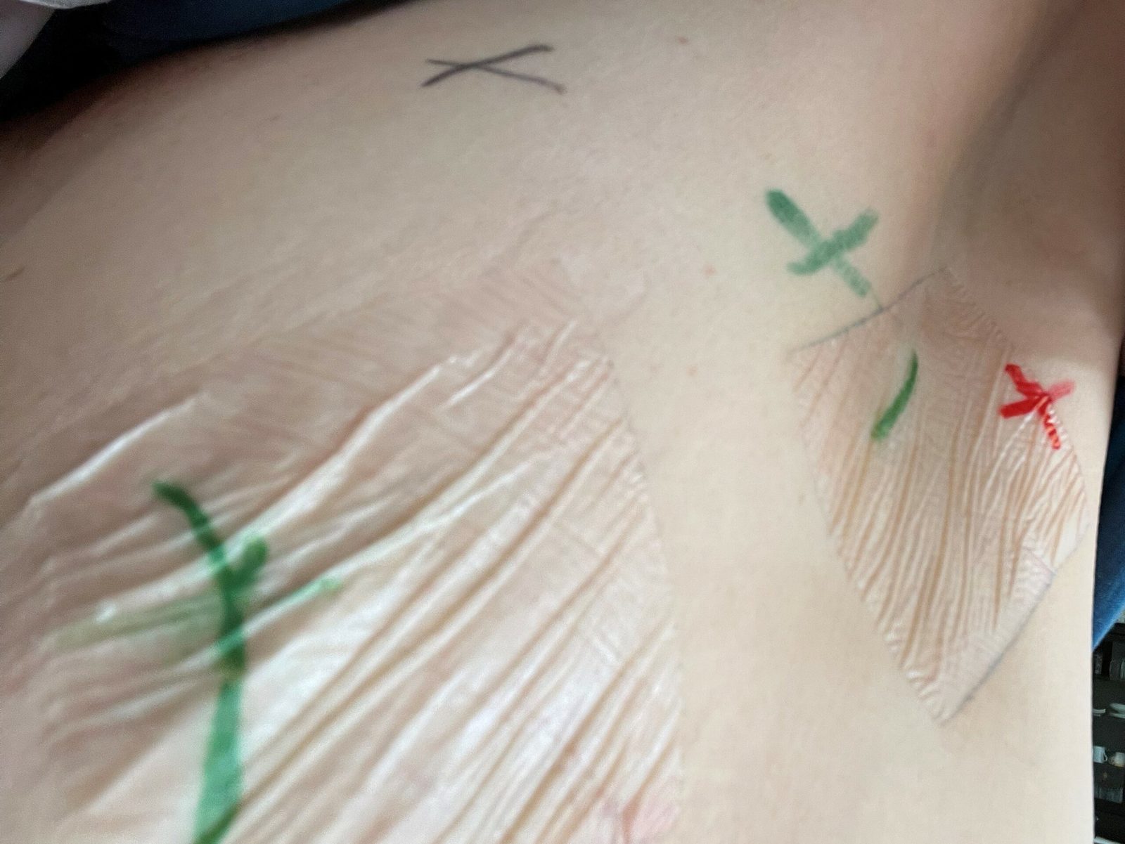Markierung der Lymphknoten
