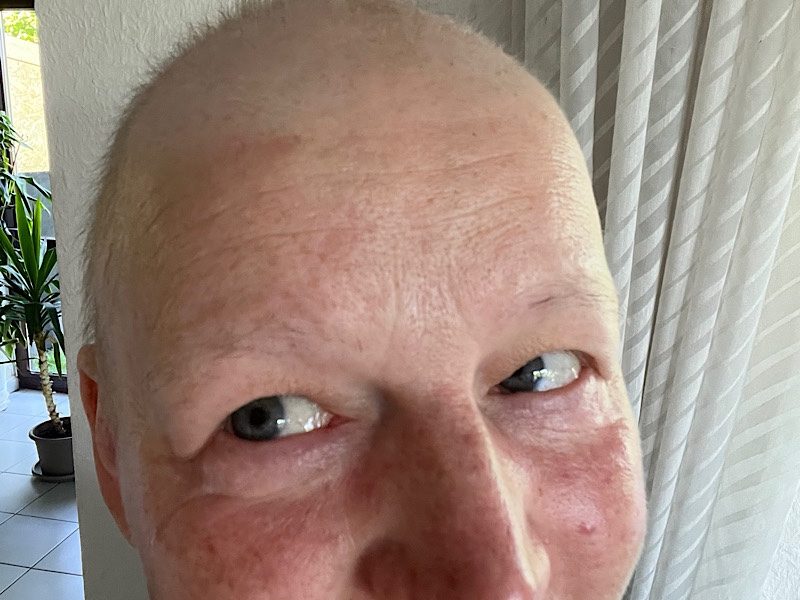 Haare an den Augenbrauen, die während der Chemotherapie nicht ausgefallen sind